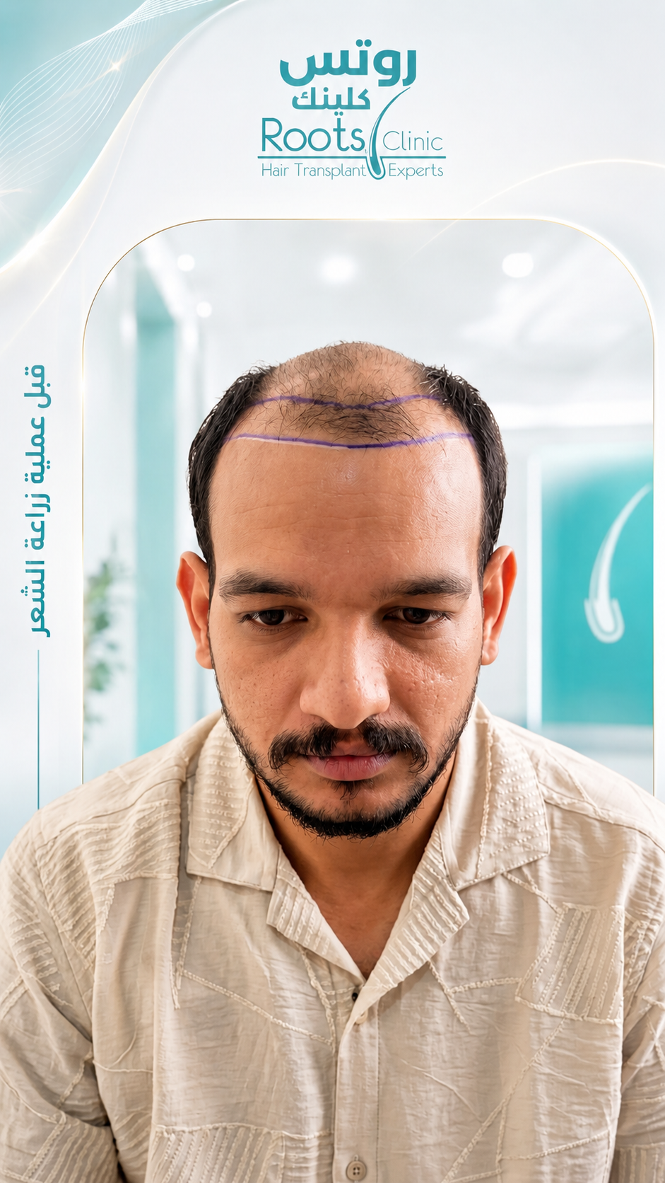 قبل زراعة خط المقدمة