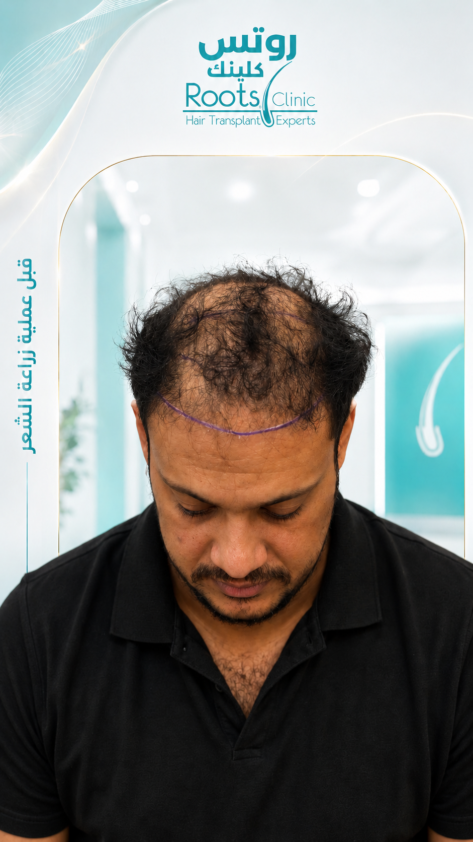 قبل زراعة منطقة التاج