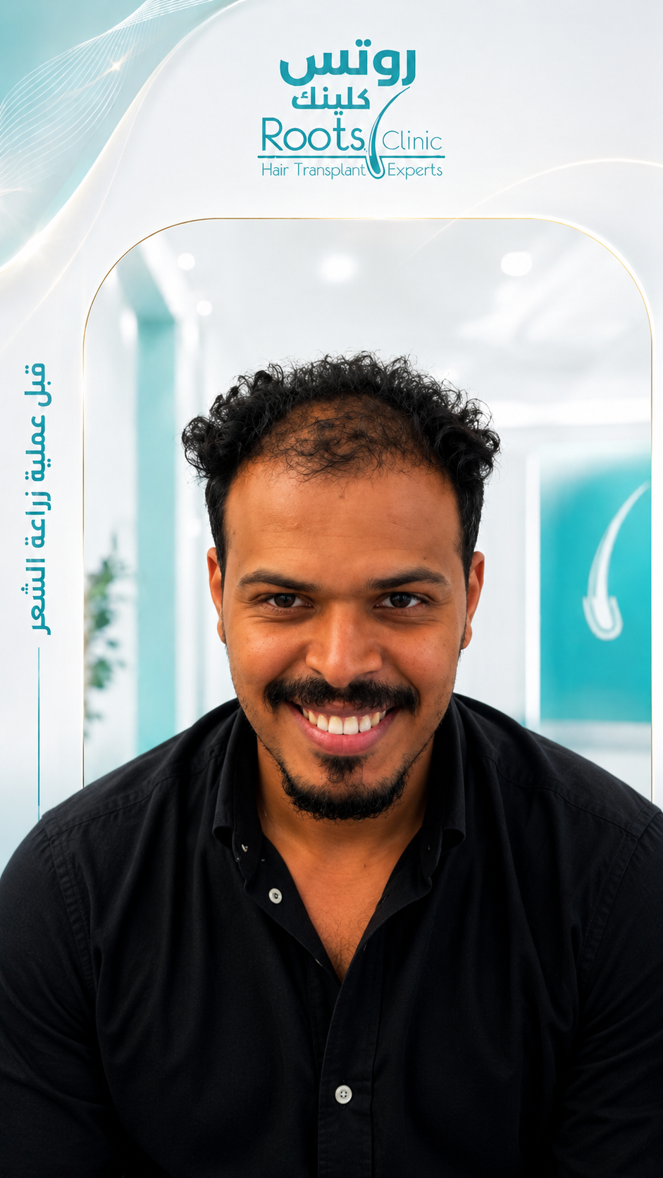قبل زراعة الشعر بدون حلاقة
