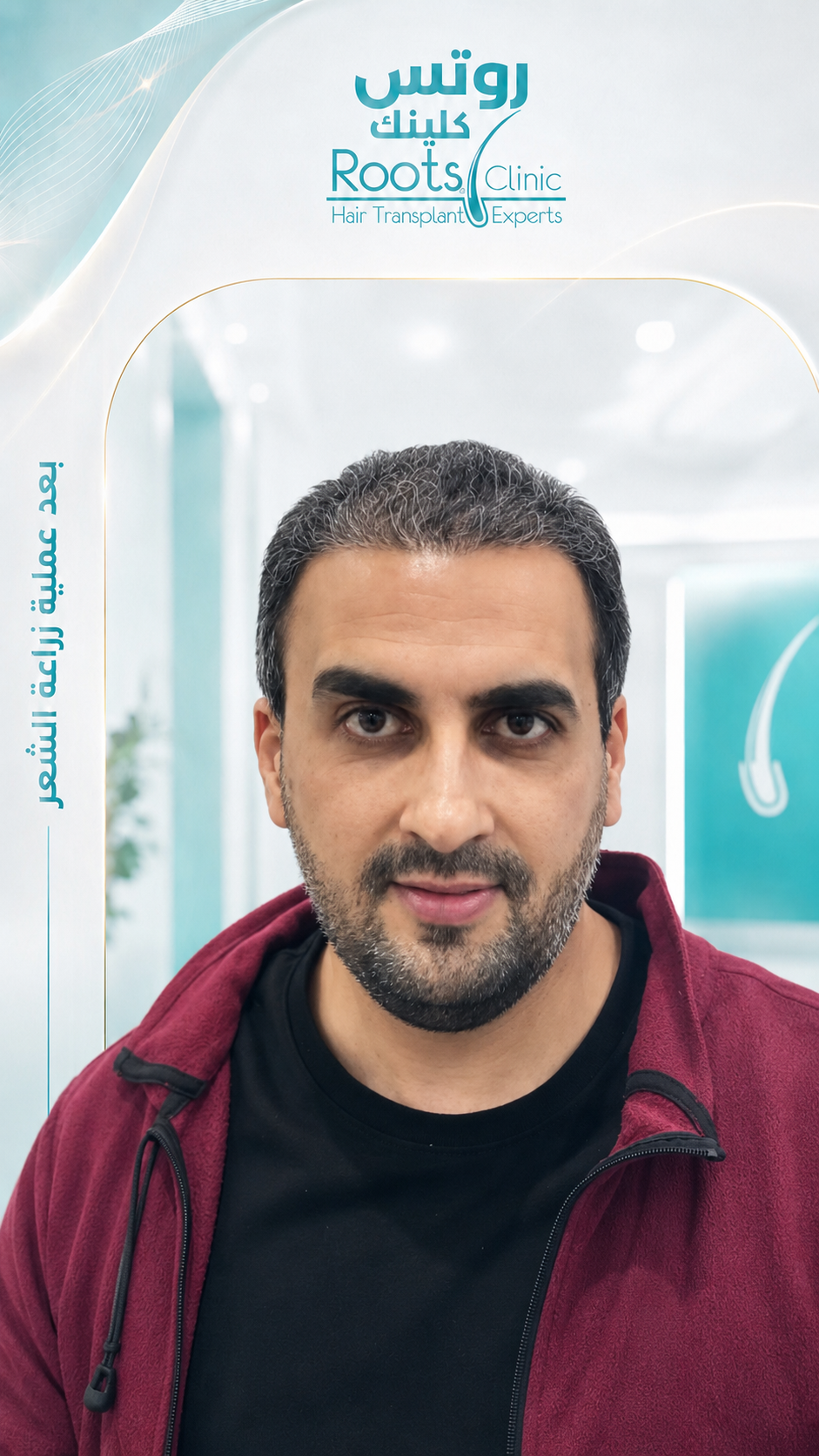 بعد زراعة الشعر DHI الحالة 1