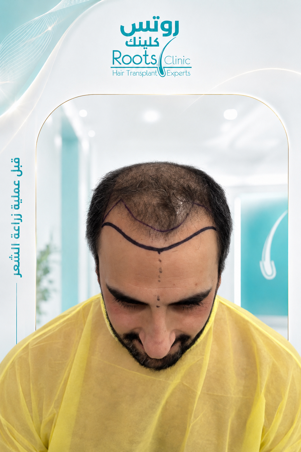 قبل زراعة الشعر DHI الحالة 1