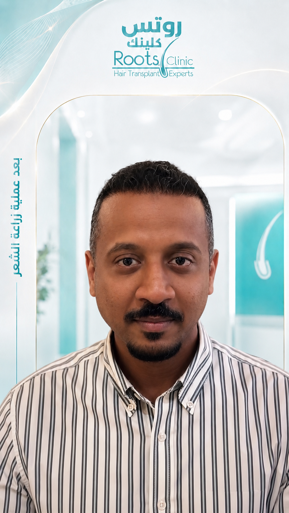 بعد زراعة الشعر DHI الحالة 2