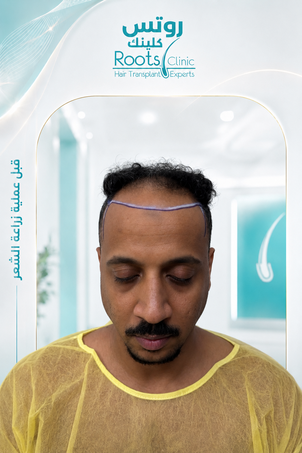 قبل زراعة الشعر DHI الحالة 2