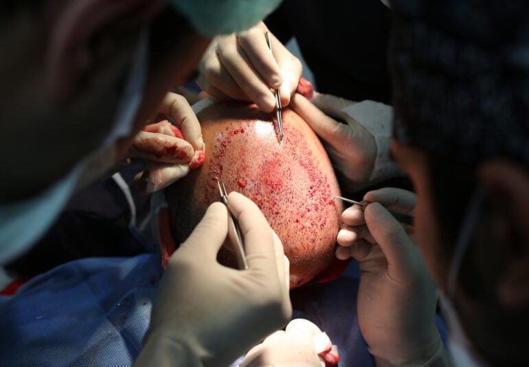 زراعة الشعر في السعودية ب افضل التقنيات