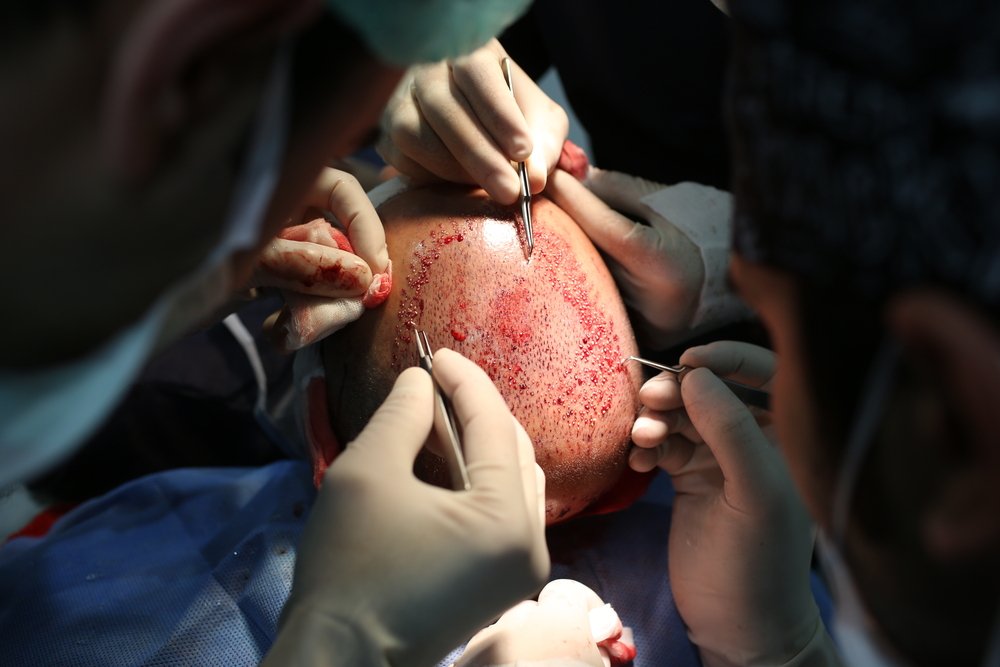 زراعة الشعر في السعودية ب افضل التقنيات